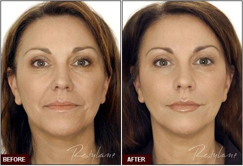 Restylane-Lyft-1920w