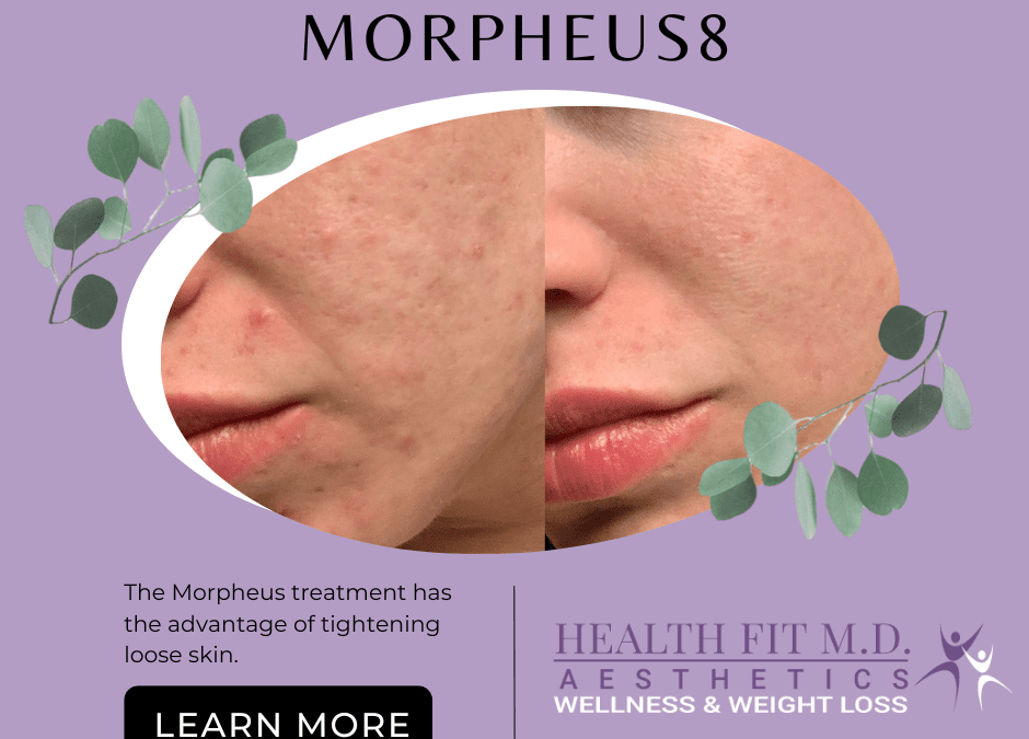 Morpheus8 RF Microneedling in Gulfport, MS