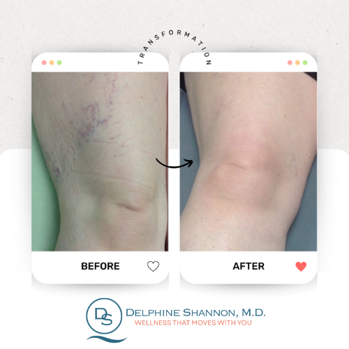 Spider Vein Removal